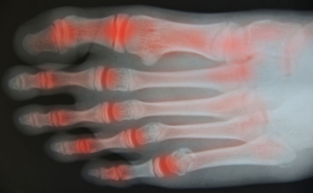 Understanding Psoriatic Arthritis in the Foot