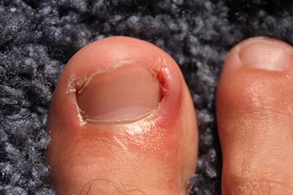 Toenails That Grow the Wrong Way