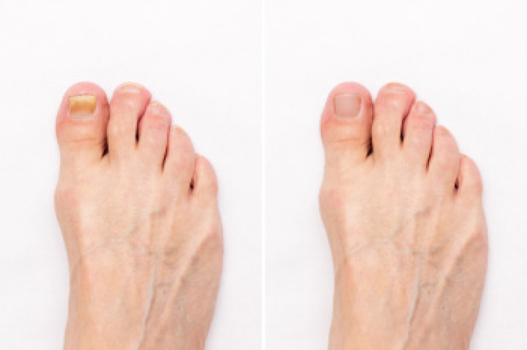 Types of Fungal Foot Infections