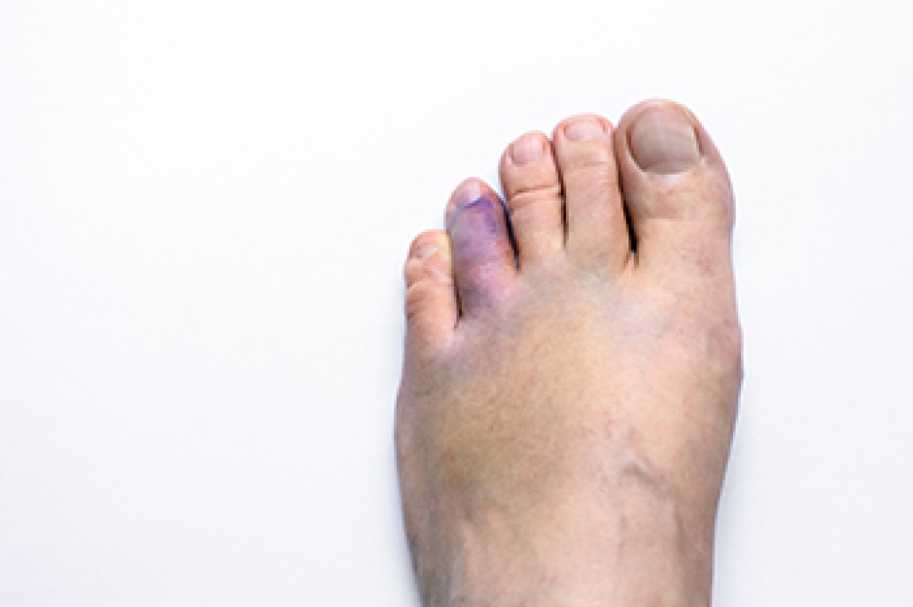 Broken Toes and Treatment Options